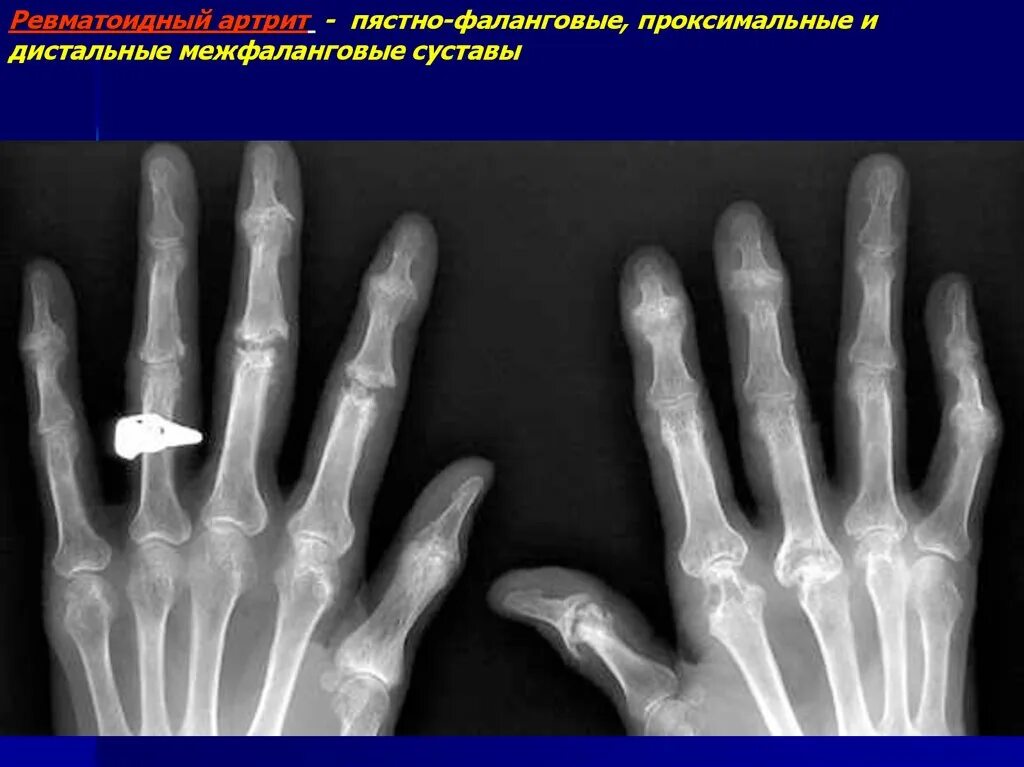 Артрит межфаланговых. Ревматоидный артрит кисти рентген. Ревматоидный артрит межфаланговые. Ревматоидный артрит дистальные межфаланговые. Ревматоидный артрит межфаланговых суставов.