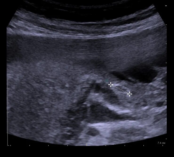 Подсаживали 2 эмбриона. УЗИ внематочной беременности 3 недели. УЗИ после подсадки эмбрионов.