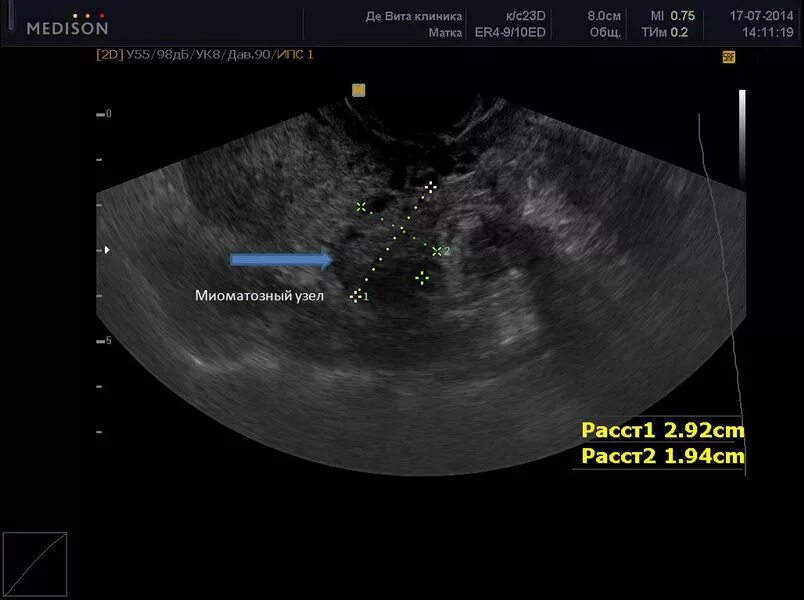 Миома шейки матки по УЗИ. Рак шейки матки на узи виден