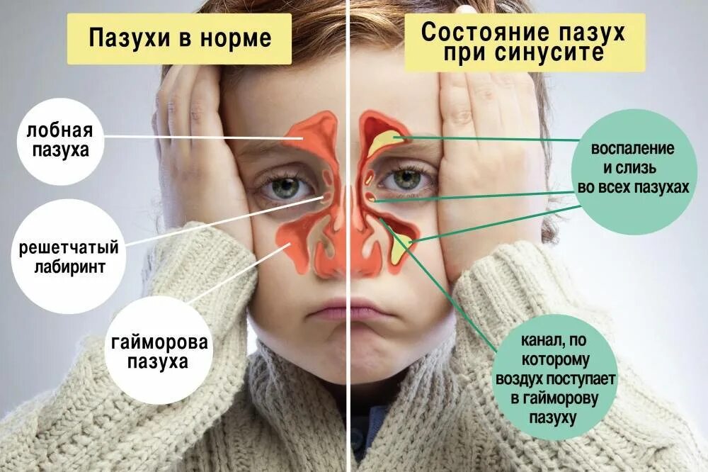 Гайморит носа симптомы и лечение