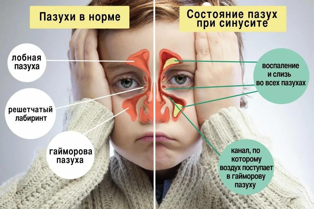 Заложенность носа 5 дней. Воспаление носовых пазух.