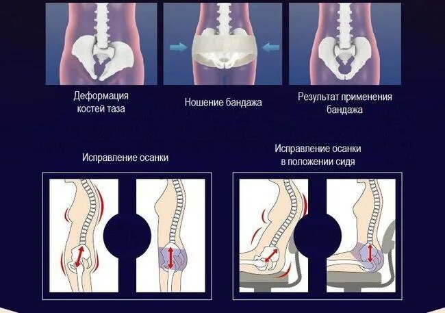 Кости таза после родов. Тазовые кости при родах. Тазовые кости расходятся. Расширение костей таза при родах. Расширение таза при беременности