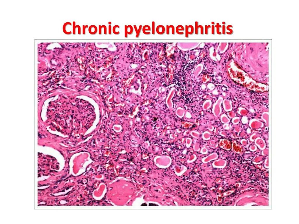 Острый гнойный пиелонефрит. Межуточный Гнойный нефрит. Эмболический Гнойный нефрит патанатомия. Межуточный нефрит гистология. Тубулоинтерстициальный нефрит гистология.