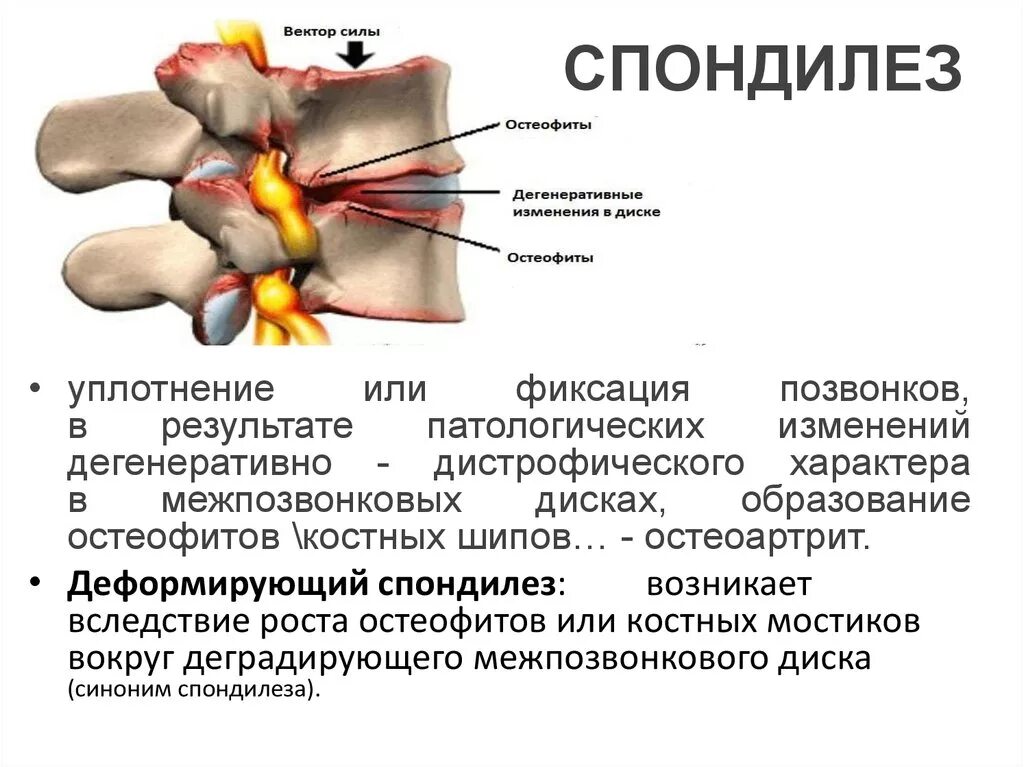 Спондилеза спондилоартроза поясничного отдела позвоночника. Спондилёз пояснично-крестцового отдела l1 l2. Спондилёз грудного отдела позвоночника th7. Спондилёз поясничного отдела позвоночника что это такое. Деформирующий спондилез l2 l5.