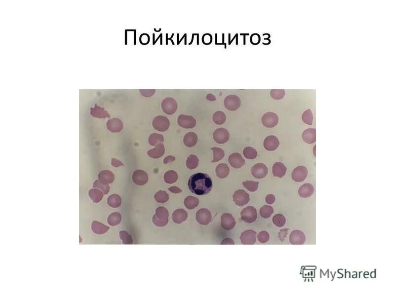 Пойкилоцитоз анемия. Анизоцитоз и пойкилоцитоз. Сидеробластная анемия картина крови.