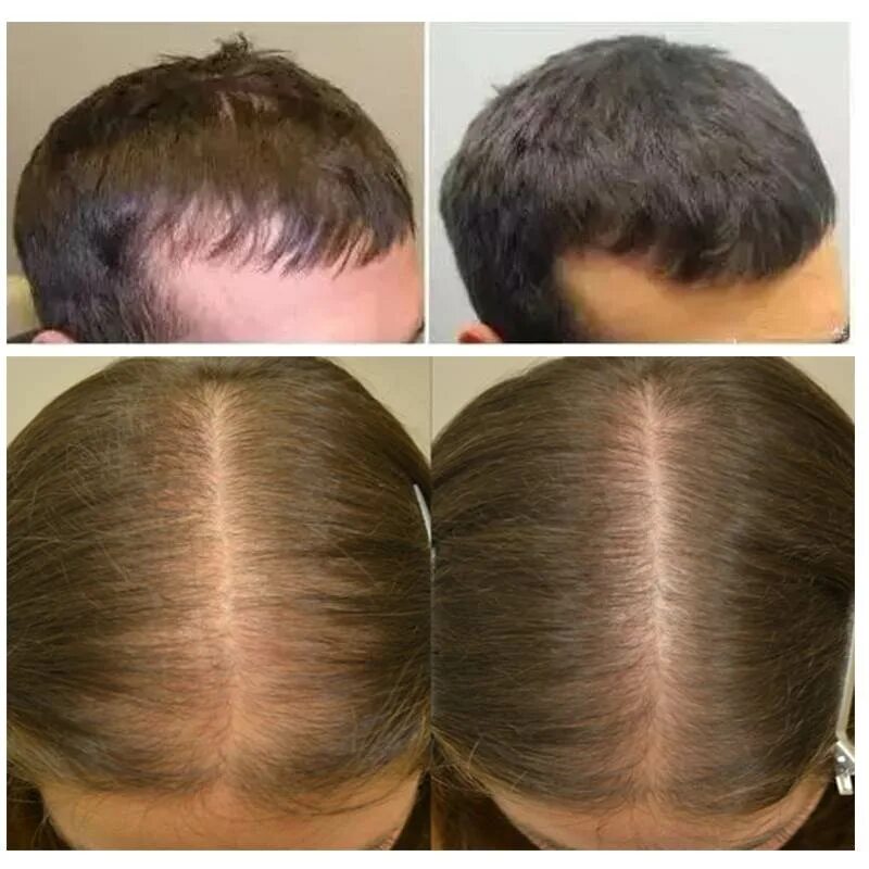 Андрогенная алопеция миноксидил. Миноксидил 5 для волос для мужчин для головы. Как усилить рост волос