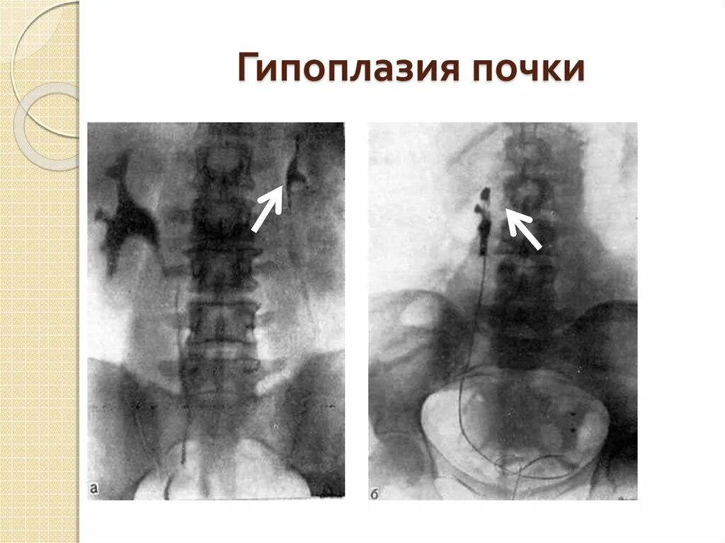 Гамартома селезенки кт. Гемангиома селезенки кт. Добавочная долька селезенки. Гипоплазия доли легкого кт. Лимфосаркома селезенки узи.