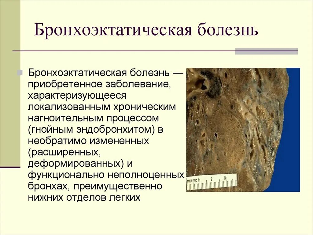 Мкб заболевание легких. Бронхоэктатическая болезнь мкб. Бронхоэктатическая болезнь мкб 10. Мкб бронхоэктатическая болезнь легких. Мкб 10 бронхоэктатической болезни.