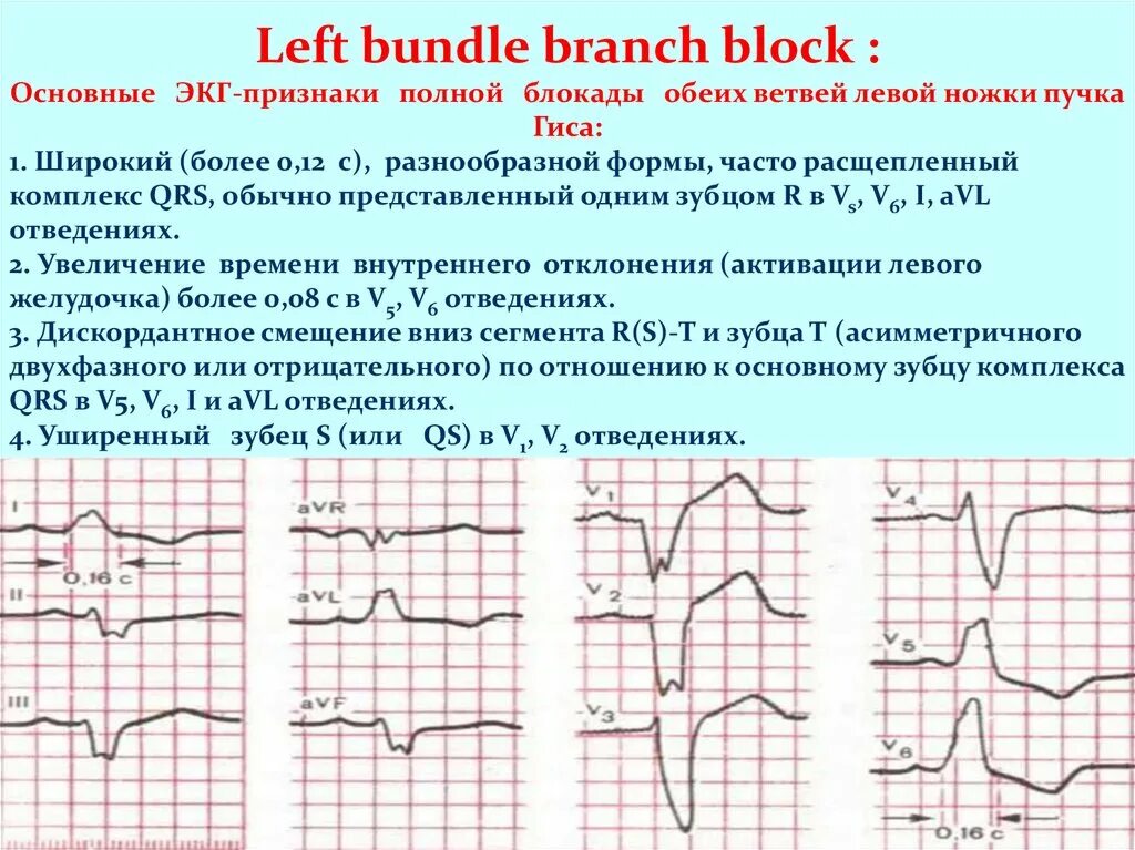 Признаки блокада левой ножки. Блокады пучка Гиса на ЭКГ признаки. Блокада ЛНПГ на ЭКГ. Блокада левой задней ножки пучка Гиса. ЭКГ при блокаде ножек пучка Гиса и ветви левой ножки.