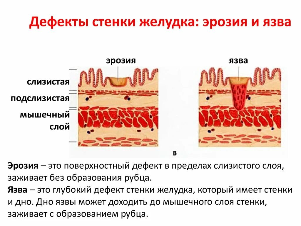 Люнд слизистой оболочки. Эрозия и язва желудка различия.