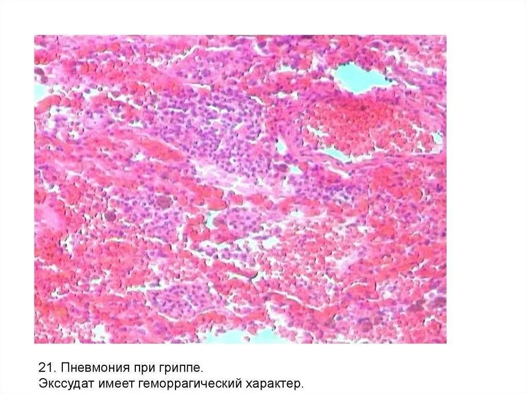 Геморрагическое воспаление легкого макропрепарат. Гриппозно геморрагическая пневмония патанатомия. Пневмония при гриппе макропрепарат. Геморрагическая пневмония при гриппе макропрепарат.