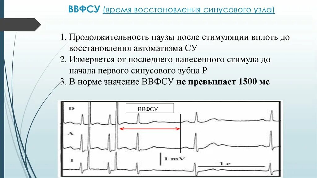 Дисфункция синусового узла что это. Дисфункция синусового узла ЭКГ. Время восстановления функции синусового узла в норме. Слабость синусового узла на ЭКГ. ЭКГ при нарушениях функции АВТОМАТИЗМА синусового узла.