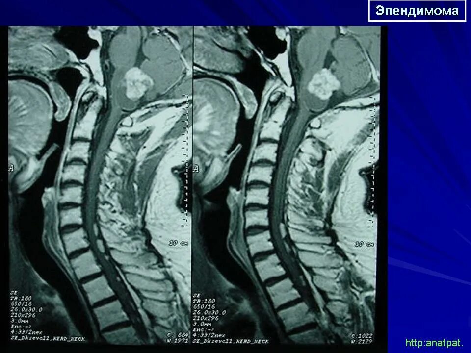 Эпендимома спинного. Эпендимома конского хвоста спинного мозга. Злокачественная эпендимома. Миксопапиллярная эпендимома. Эпендимома спинного мозга мрт.