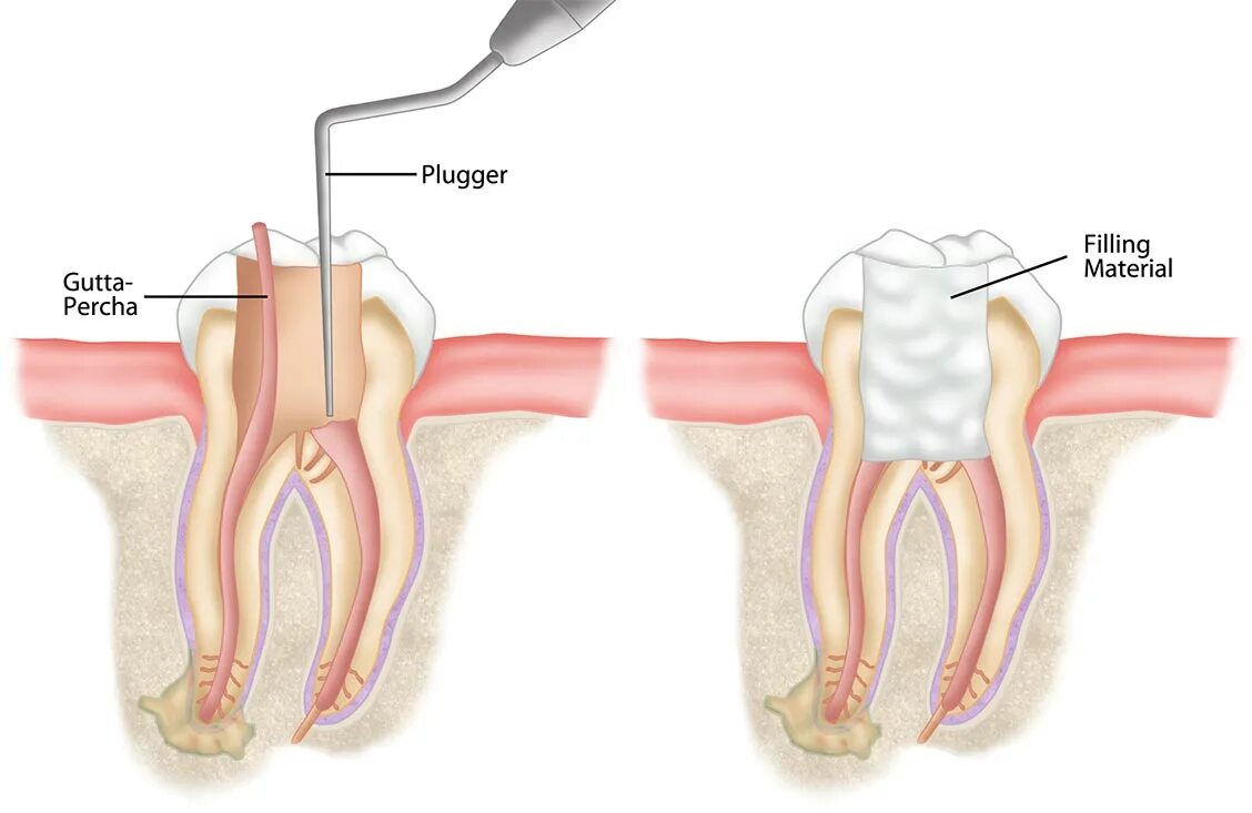 Пломбирование корневого канала зуба гуттаперчевыми штифтами. Гуттаперча для пломбирования корневых каналов. Пломбировка корневого канала гуттаперчей. Временное пломбирование корневых