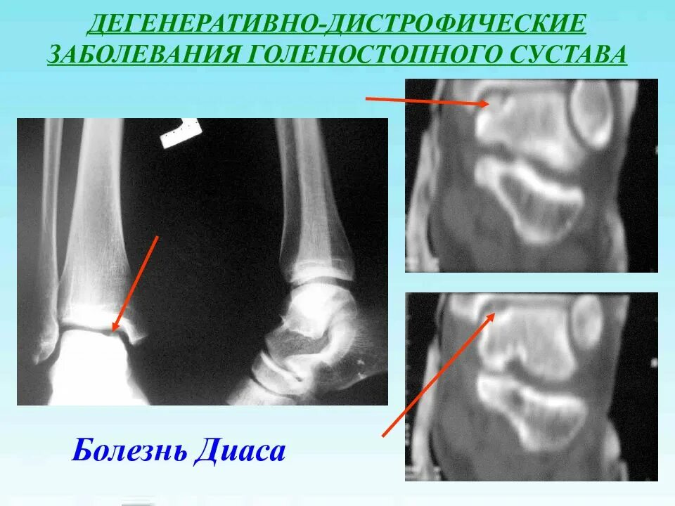 Артроз голеностопного сустава рентген. Хронический артрит лодыжек. Воспаление голеностопного сустава. Дистрофические изменения в голеностопном суставе.