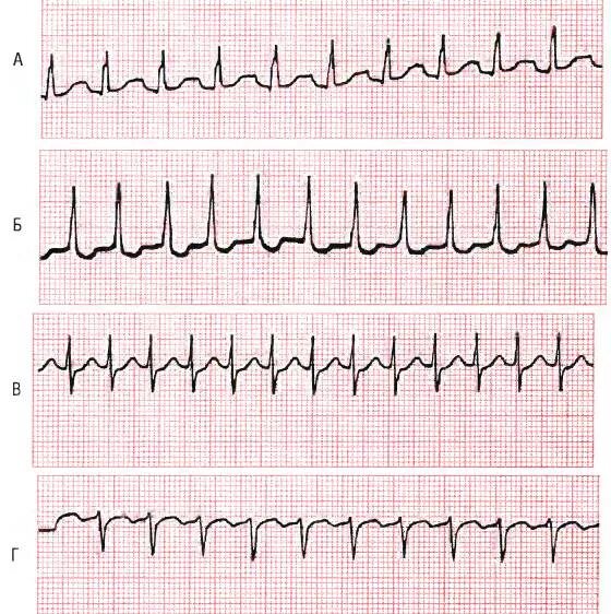 Тахикардия qrs. Синусовая тахиаритмия на экг. пароксизмальная тахикардия с узким комплексом qrs на экг. тахикардия с узким qrs экг. наджелудочковая тахикардия с узкими комплексами qrs.