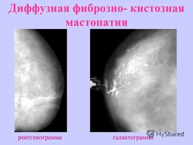 Диффузно фиброзной