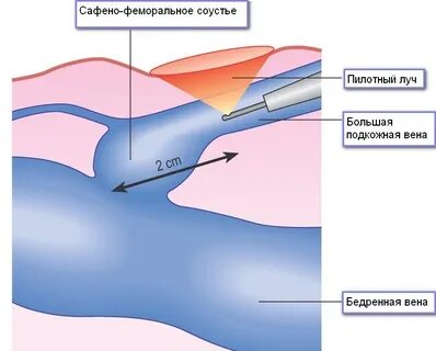 Сафено феморальное соустье