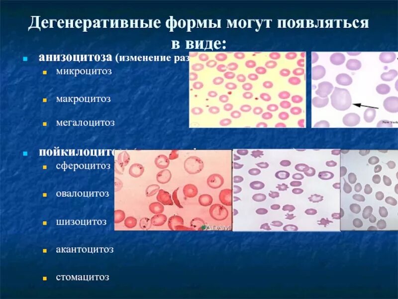 Пониженные макроциты. Микроцитоз макроцитоз анизоцитоз. Макроцитоз и мегалоцитоз. Микроцитоз анизоцитоз пойкилоцитоз. Гиперхромия макроцитоз.