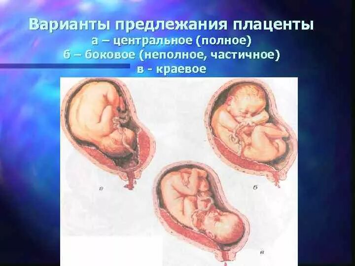 Краевое предлежание хориона