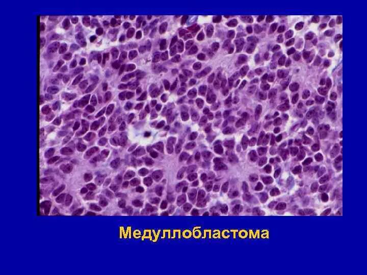 Медуллобластома это. Медуллобластома гистология. медуллобластома патологическая анатомия. медуллобластома микропрепарат описание. медуллобластома морфология.