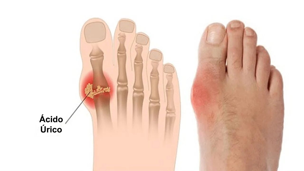Почему болит кость пальца. Подагра большого пальца ноги. Боли сустава пальца стопы подагра.