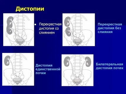 Тазовая дистопия