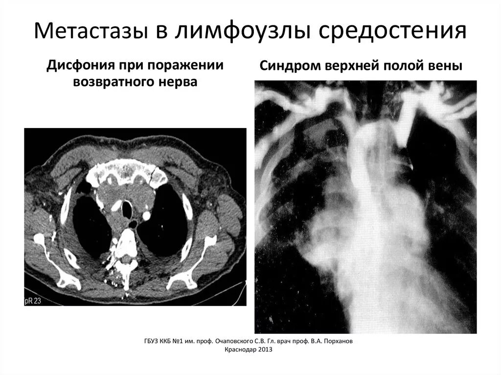 Лимфоузлы средостения кт. Метастатическое поражение лимфатических узлов. Признаки метастатического поражения лимфоузлов кт. Лимфатические узлы без признаков метастатического поражения. Метастазированные лимфоузлы