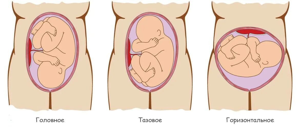 Головное и тазовое предлежание плода. Головковое предлежание плода. Головное предлежание плода при беременности. Головное предлежание плода на 23 неделе беременности. 36 недель тазовое