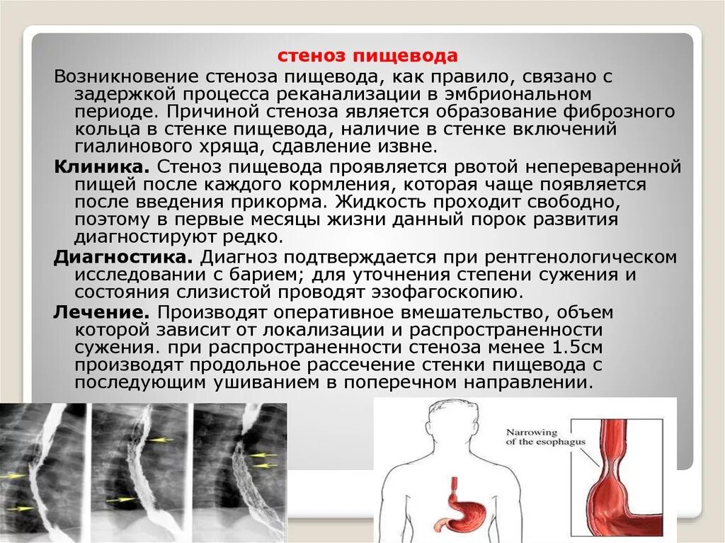 Сужение пищевода лечение