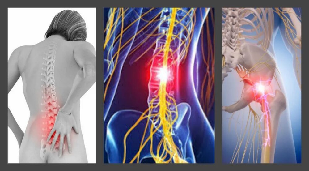 Радикулит боли в пояснице. Дорсопатия пояснично-крестцового. Радикулопатия s1 симптомы. Дорсопатия l4 l5. Радикулопатия с7-с8.