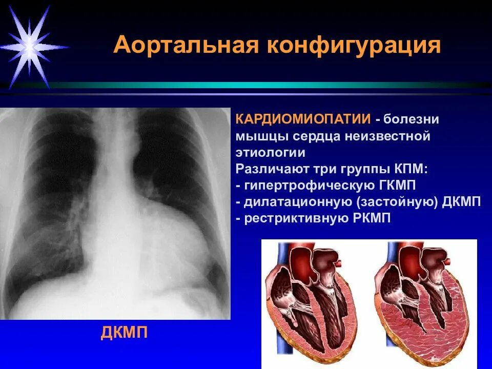 Заболевания мышц сердца. Аортальная конфигурация сердца. аортальная конфигурация сердца заболевания. конфигурация сердца лучевая диагностика. конфигурация сердца при дилатационной кардиомиопатии.