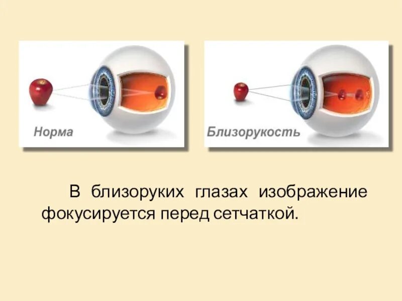 Изображение фокусируется перед сетчаткой. Изображение предметов фокусирующихся перед сетчаткой это. У близоруких людей изображение фокусируется. Близорукость изображение фокусируется перед сетчаткой. Лучи света фокусируются за сетчаткой