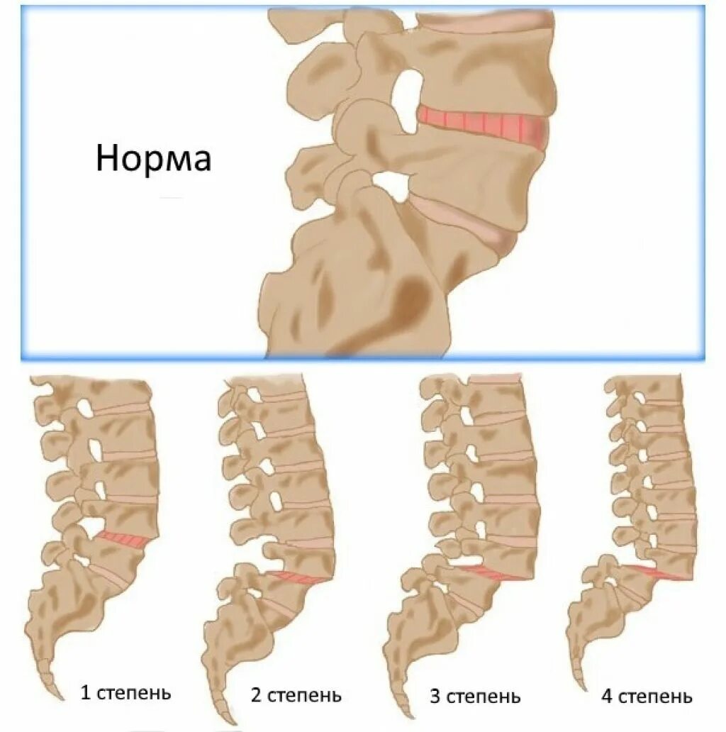 Спондилолистез – смещение позвонков. Спондилолистез 5 поясничного позвонка. Спондилолистез грудного отдела позвоночника. Спондилолистез 3 степени поясничного отдела позвоночника. Вправление позвоночника