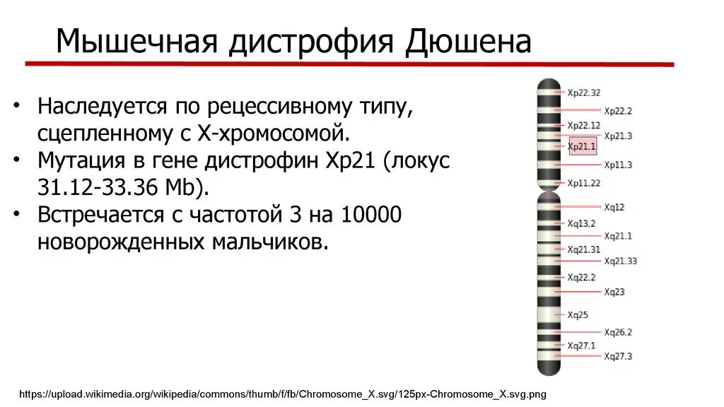 Прогрессирующая мышечная дистрофия тест нмо. Дистрофия дюшенна кариотип. болезнь дюшенна кариотип. ген миодистрофии дюшенна. миодистрофия дюшенна кариотип.