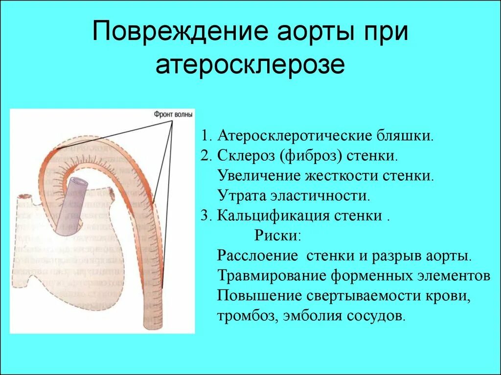 Кальциноз грудной аорты. Кальциноз атеросклероз аорты. Дуга аорты склерозирована что это такое. Атеросклеротические изменения стенок аорты.