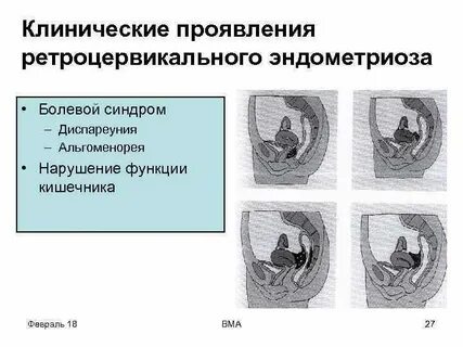 Эндометриоз локализация