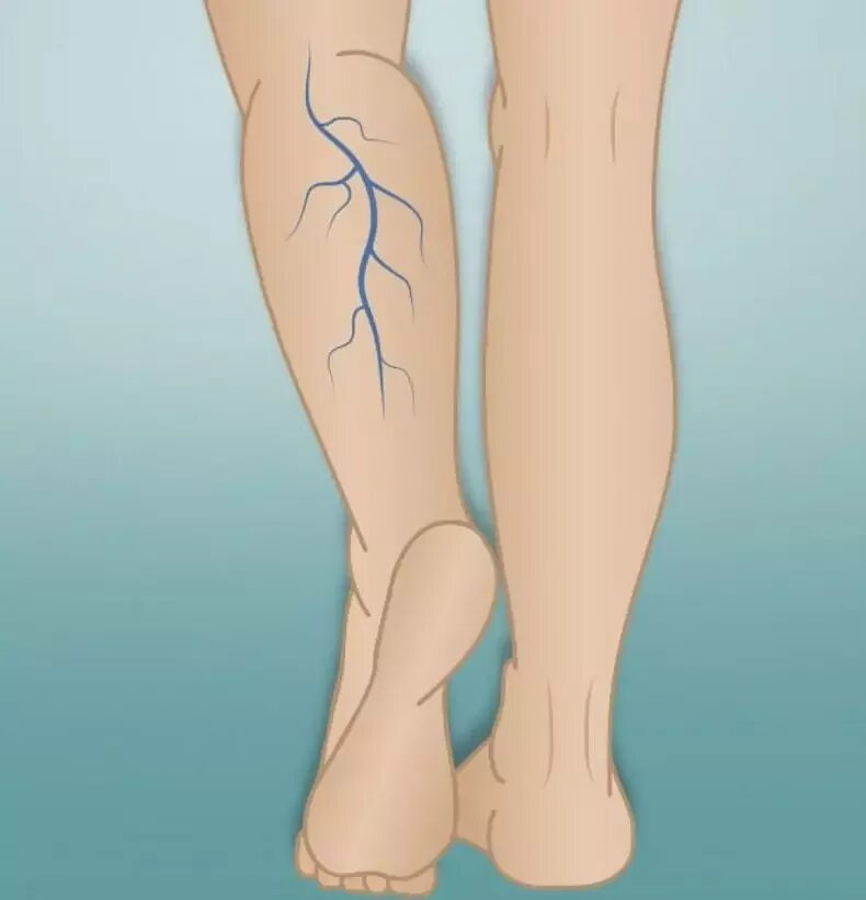 Что значат вены на ногах. Варикозное расширение вен ступни. Варикозное расширение вен (ВРВ) нижних конечностей.