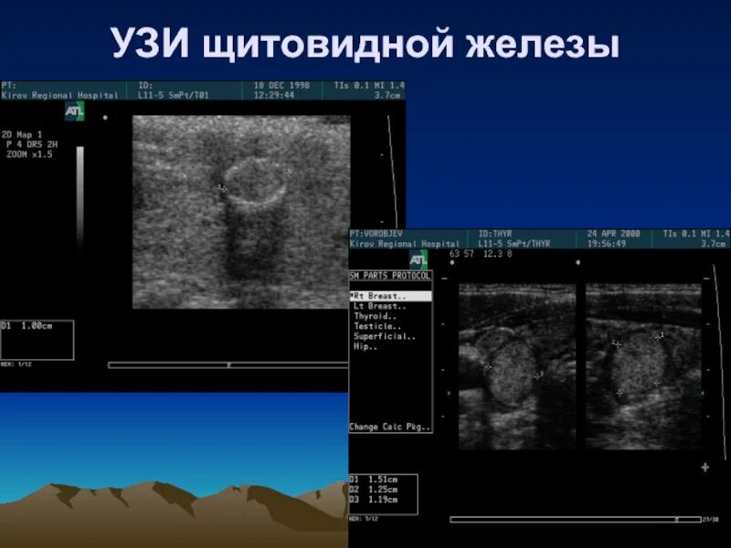 Можно ли перед узи щитовидной железы есть. УЗИ щитовидной железы УЗИ. УЗИ щитовидной железы патология. УЗИ щитовидной железы снимки. УЗИ щитовидной железы презентация.