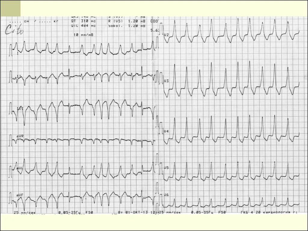 Тахисистолия это. Трепетание предсердий тахисистолия. Фибрилляция предсердий с тахисистолией желудочков. Фибрилляция предсердий тахисистолия. Трепетание предсердий ЭКГ тахисистолия.