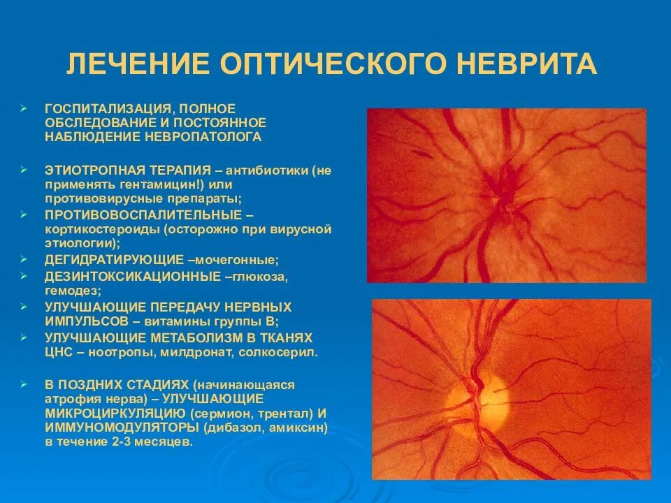 Ретробульбарный неврит зрительного. Ретробульбарный неврит (папиллит). Неврит зрительного нерва глазное дно. Неврит глазного нерва ретробульбарный.