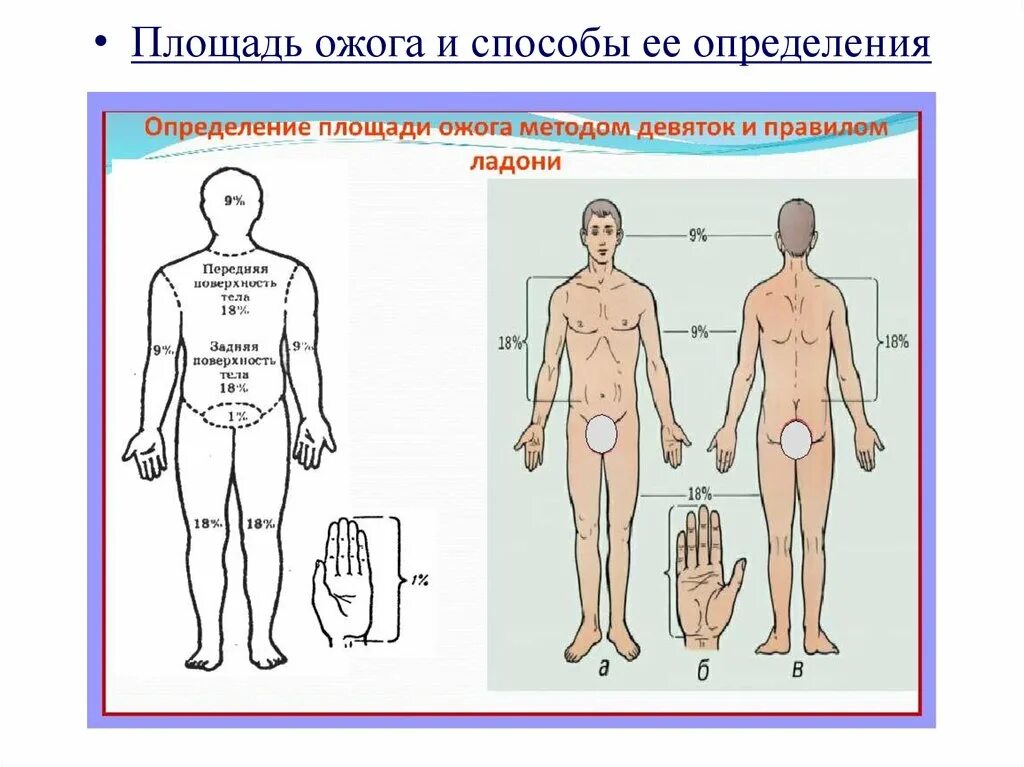 Площадь ожога определяется методом. Методика определения площади ожога. Методика измерения площади ожогов. Определить площадь ожога методом девятки. Пл тела