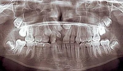 Снимок молочных зубов рентгеновский. Рентген детских зубов с молочных. Молочные зубы рентгеновский снимок.