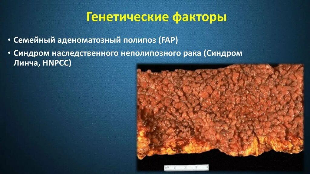 Семейный аденоматозный полипоз. Наследственный аденоматозный полипоз. Семейный наследственный полипоз. Диффузные факторы