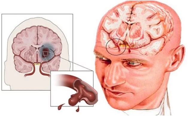 Геморрагический инсульт с кровоизлиянием в головной мозг. ОНМК ишемический и геморрагический инсульт. Поражение головного мозга геморрагический инсульт. Острое нарушение мозгового кровообращения геморрагический инсульт. Ишемия нерва