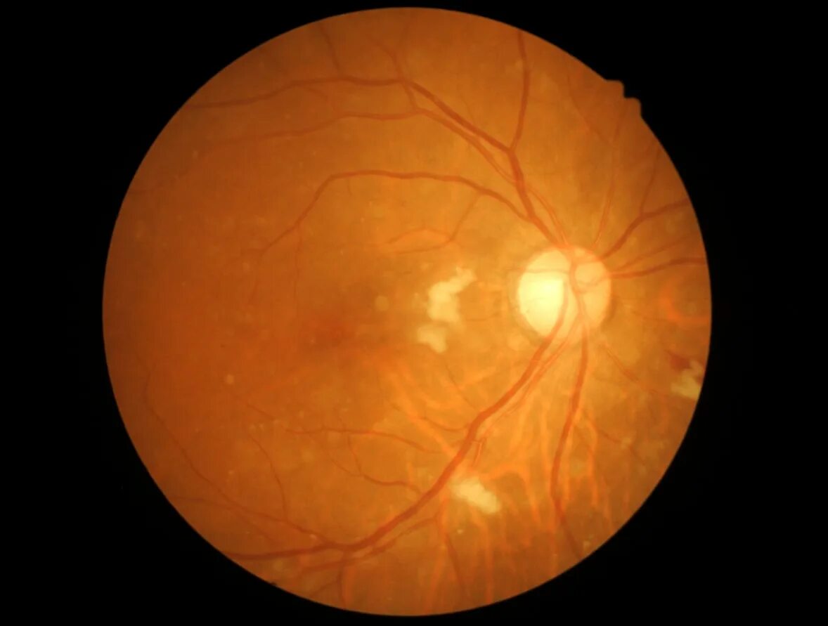 Ювенильный ретиношизис. Montagen retinal platina. Ламеллярный макулярный разрыв сетчатки. Сифилитический ретинит. Биомикрофотография глазного дна с использованием фундус-камеры.