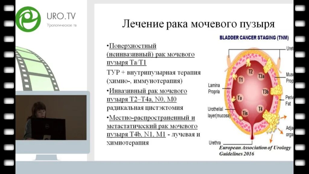 Рак мочевого сколько живут