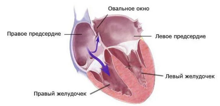 1 3 окно в сердце. Открытое овальное окно в сердце у ребенка. Открытое овальное окно в сердце у новорожденного. Незакрытое овальное окно в сердце у новорожденного. Овальное отверстие анатомия в сердце.