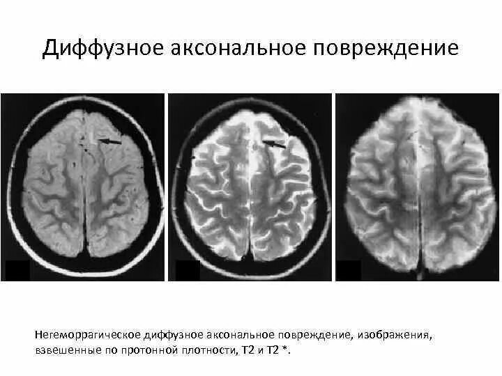 Диффузное аксональное повреждение мозга. Аксональные повреждения головного мозга. Диффузное аксональное повреждение мозга кт. Аксональное повреждение головного мозга мрт.