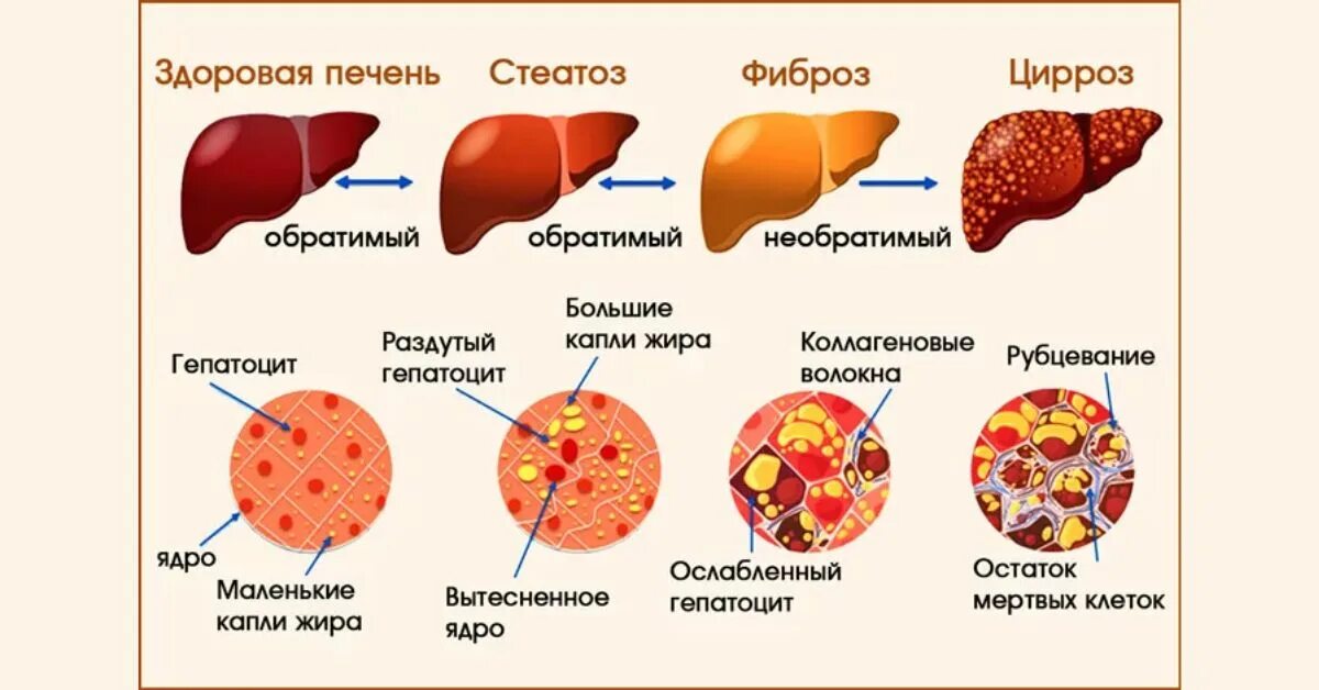 Гепатит на сколько лет. Цирроз печени стадии развития. Стадии формирования цирроза печени. Степени поражения печени при циррозе. Фазы развития цирроза печени.